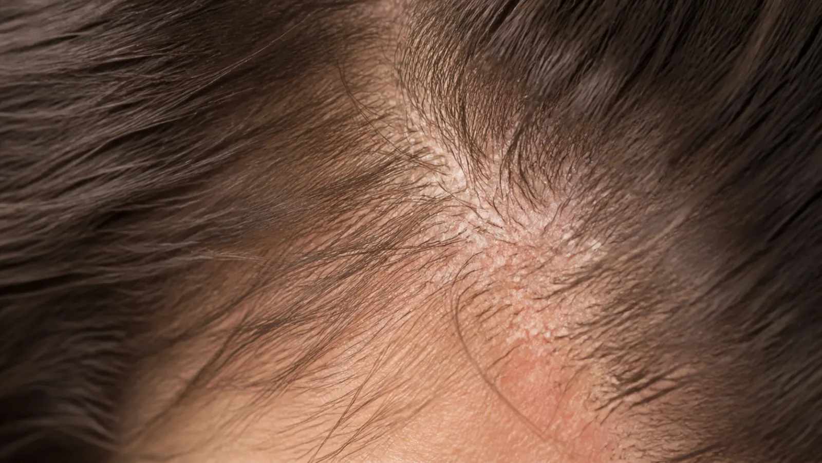 Close-up of a scalp along the part line showing dry flaking and mild redness